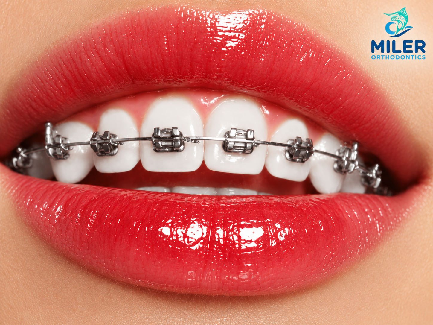 Traditional Braces for Adults Miler Orthodontics dentist in Bluffton South Carolina orthodontist