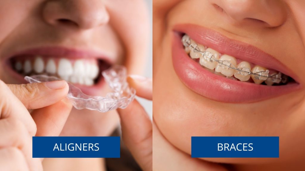 Close-up comparison of clear aligners and ceramic braces for teeth straightening