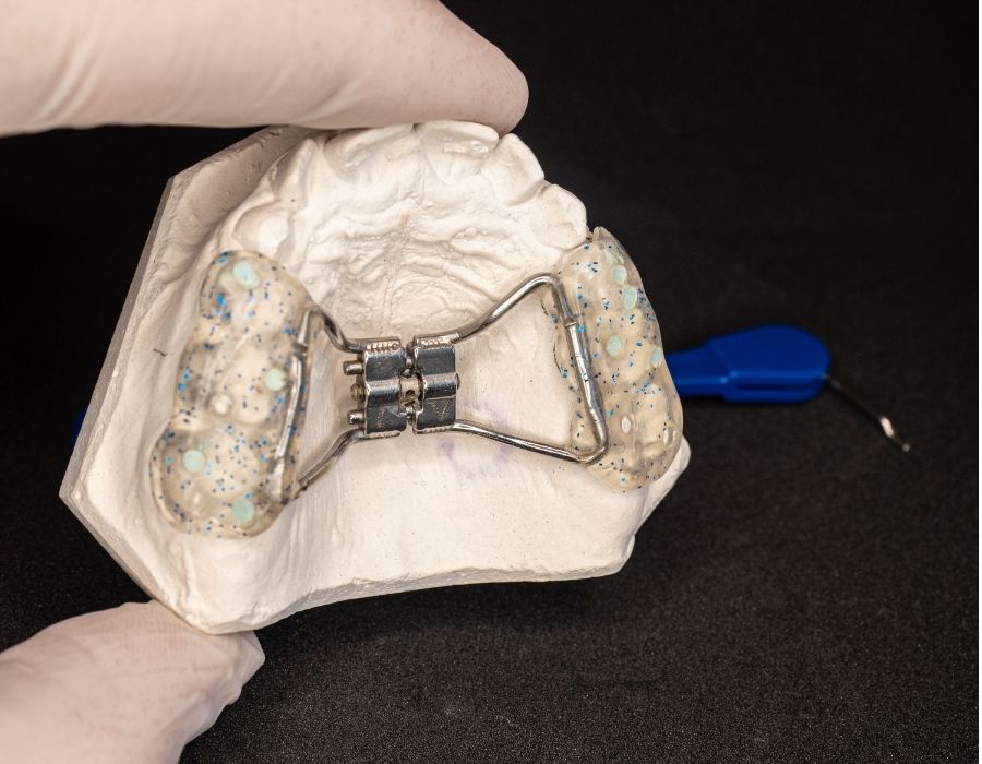 Palatal expander fitted on dental cast for orthodontic jaw expansion