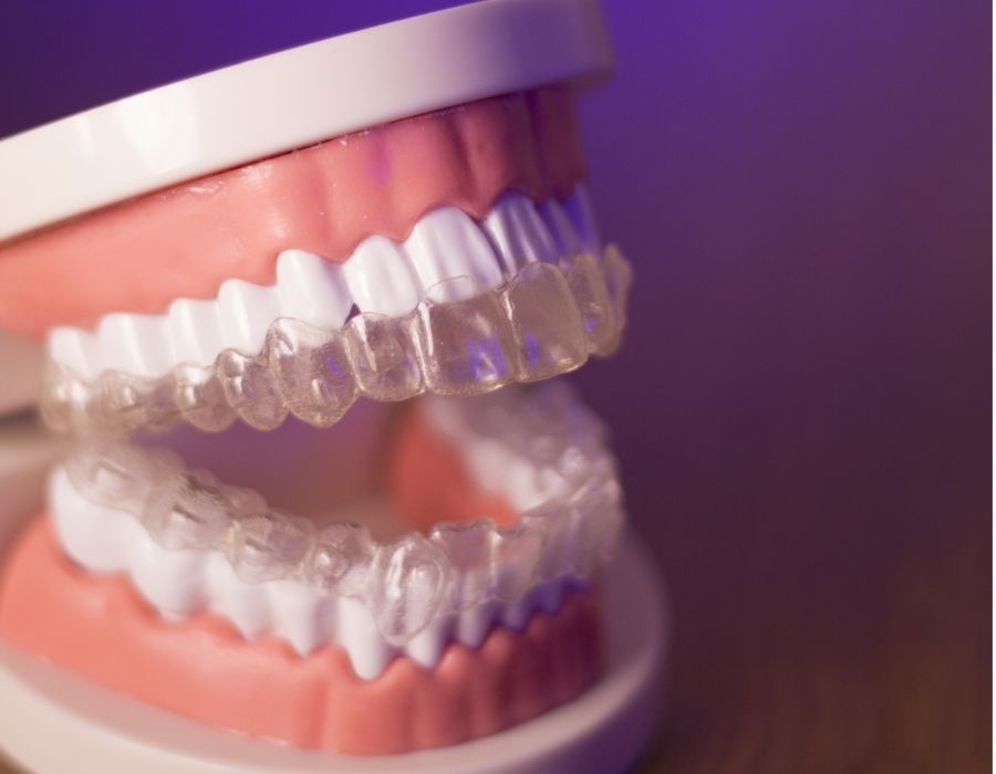 Dental model with invisalign demonstrating orthodontic treatment