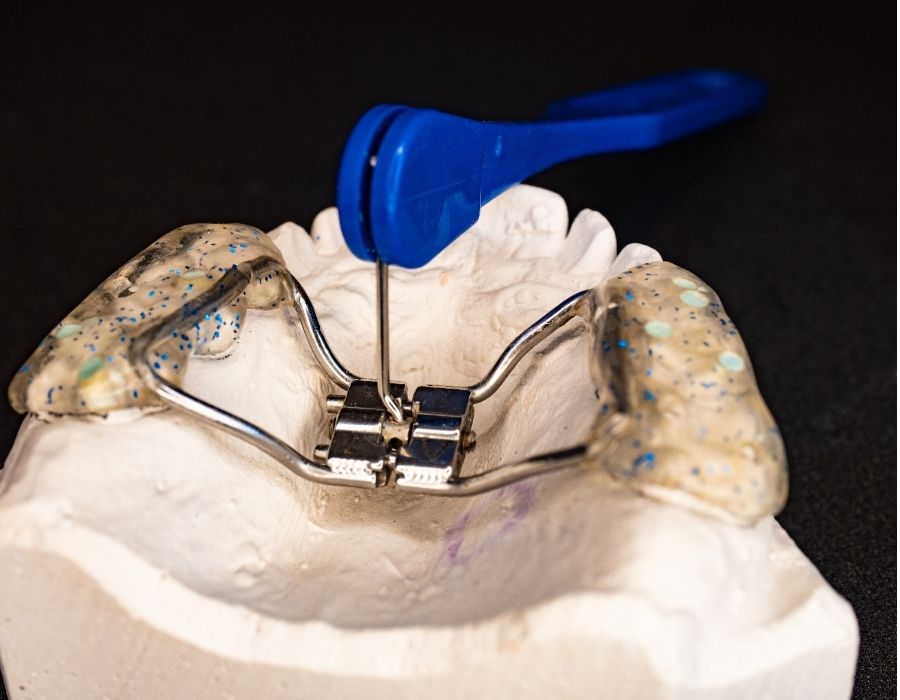 Palatal expander being adjusted with key tool on dental mold