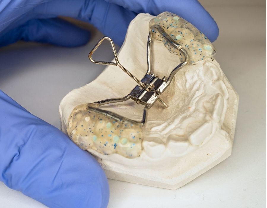 Palatal expander appliance on dental mold used for orthodontic treatment
