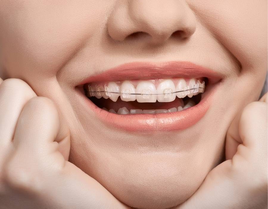 Smiling woman wearing ceramic braces for TMJ relief and jaw alignment, showcasing modern orthodontic treatment for temporomandibular joint disorder.