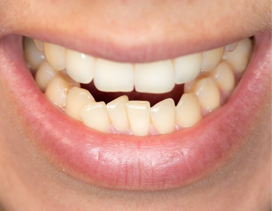 Close-up of a smile with crowded bottom teeth and straight upper teeth, demonstrating mild dental misalignment often treated with orthodontics.