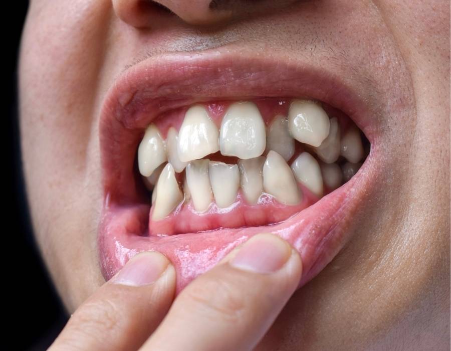 Close-up of a person showing crowded teeth and gum misalignment, highlighting the need for orthodontic treatment to correct dental crowding.