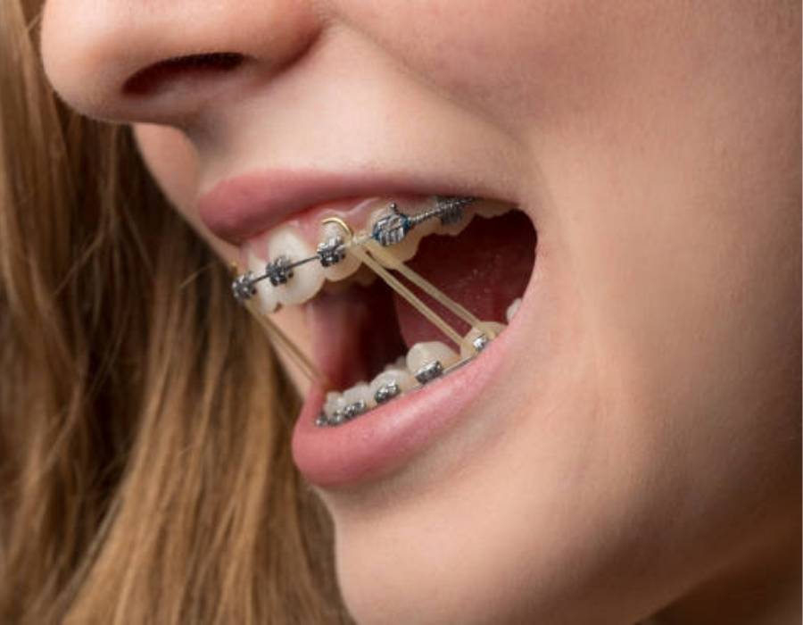 Side view of teen wearing custom orthodontic braces with elastic bands for bite correction and jaw alignment.