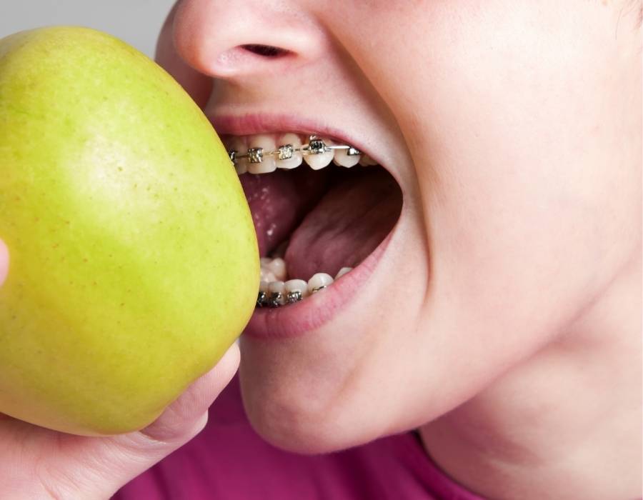 Close-up of person with metal braces biting into a green apple, illustrating challenges of eating with orthodontic braces.