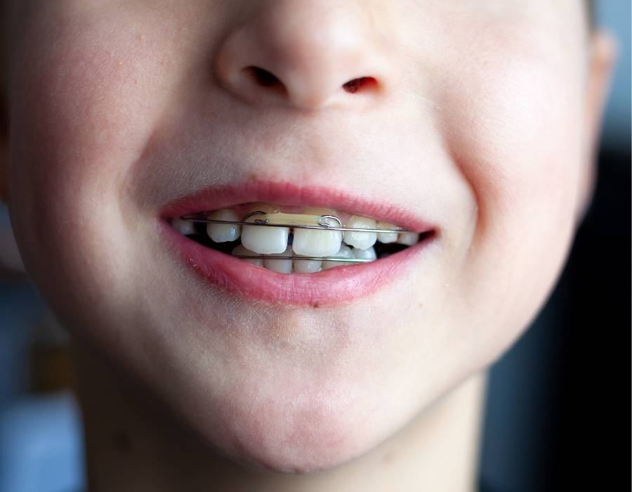 Close-up of a child smiling while wearing orthodontic braces.