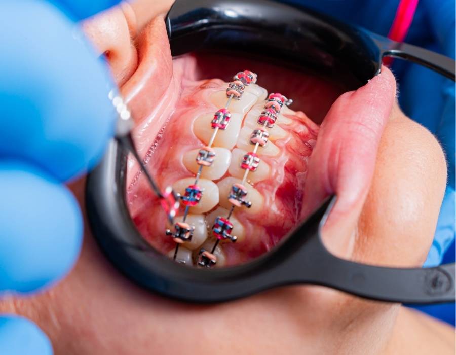 Close-up of orthodontic braces adjustment showing dental professional working on jaw alignment and bite correction for improved oral health.