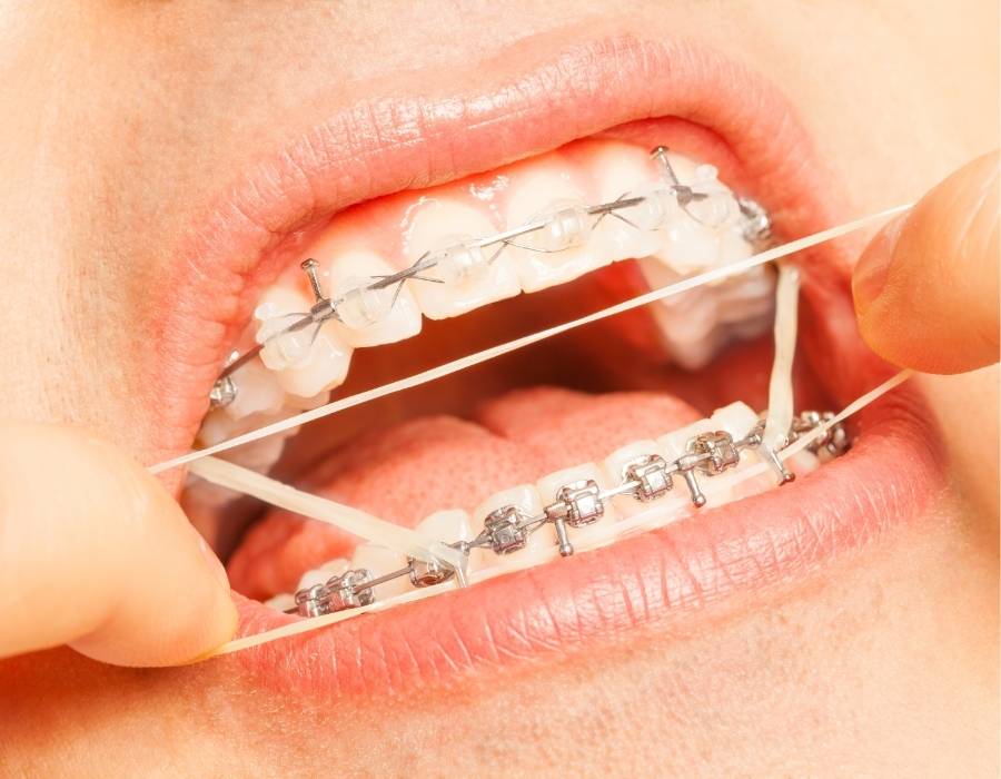 Close-up of orthodontic elastics being applied to braces for correcting open bite and crossbite, demonstrating advanced dental alignment treatment.