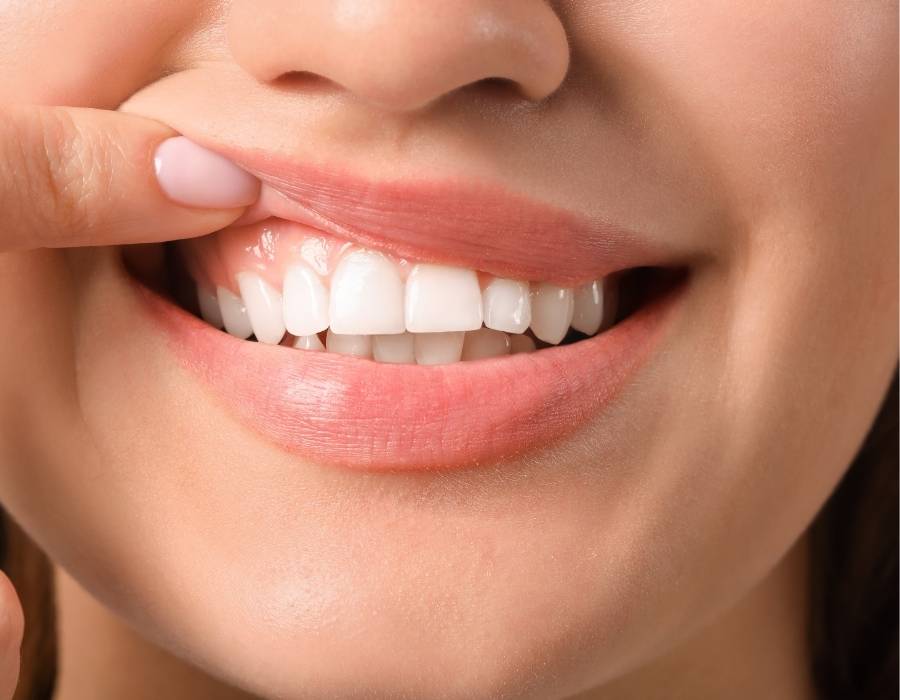 Close-up of a woman lifting her upper lip to reveal healthy gums and straight white teeth after orthodontic care.