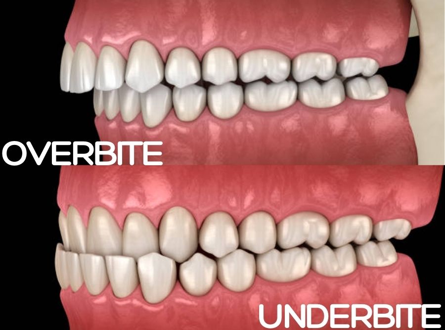 Illustration comparing overbite and underbite showing differences in upper and lower teeth alignment