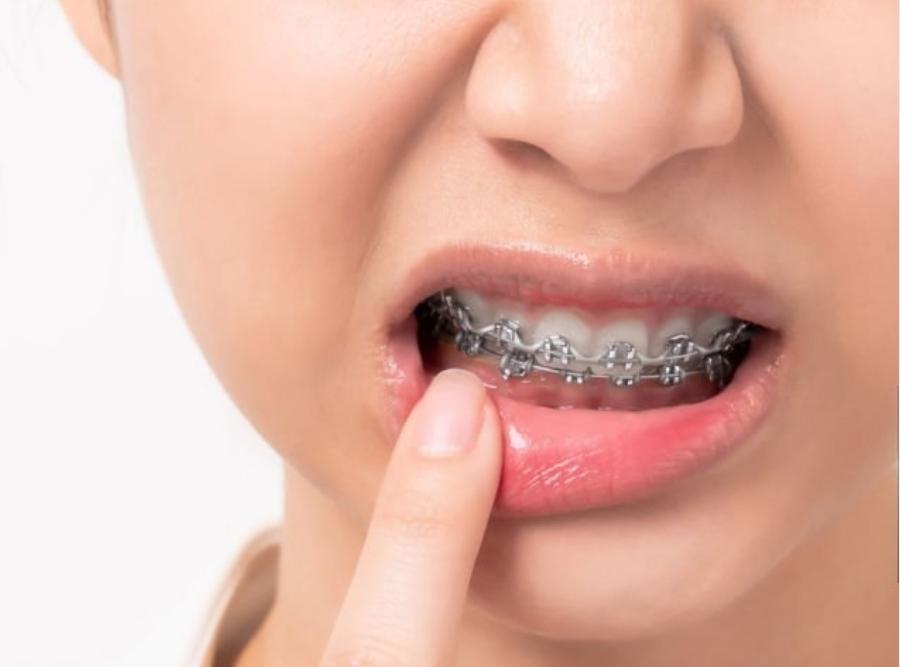 having teeth issue with braces on