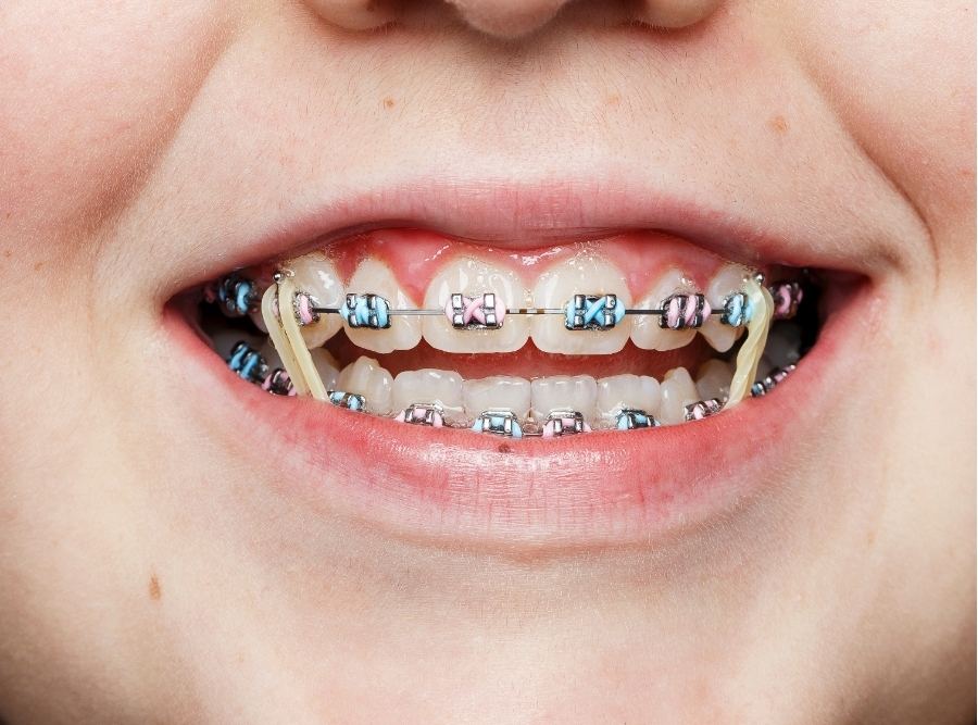 Close-up of a child's smile with colorful pink and blue braces and thick orthodontic rubber bands connecting the upper and lower teeth