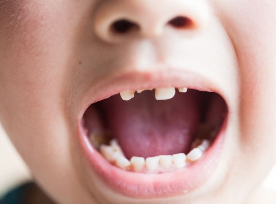 Close-up of a child's open mouth showing baby teeth with visible dental cavities and decay on the upper incisors