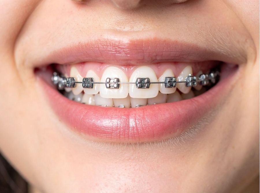 Close-up of a person smiling with silver metal orthodontic braces on their upper and lower teeth.
