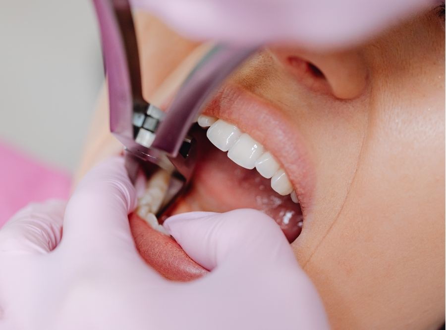 Close-up of a dentist in pink gloves using surgical forceps to perform a tooth extraction on a patient's lower molar.