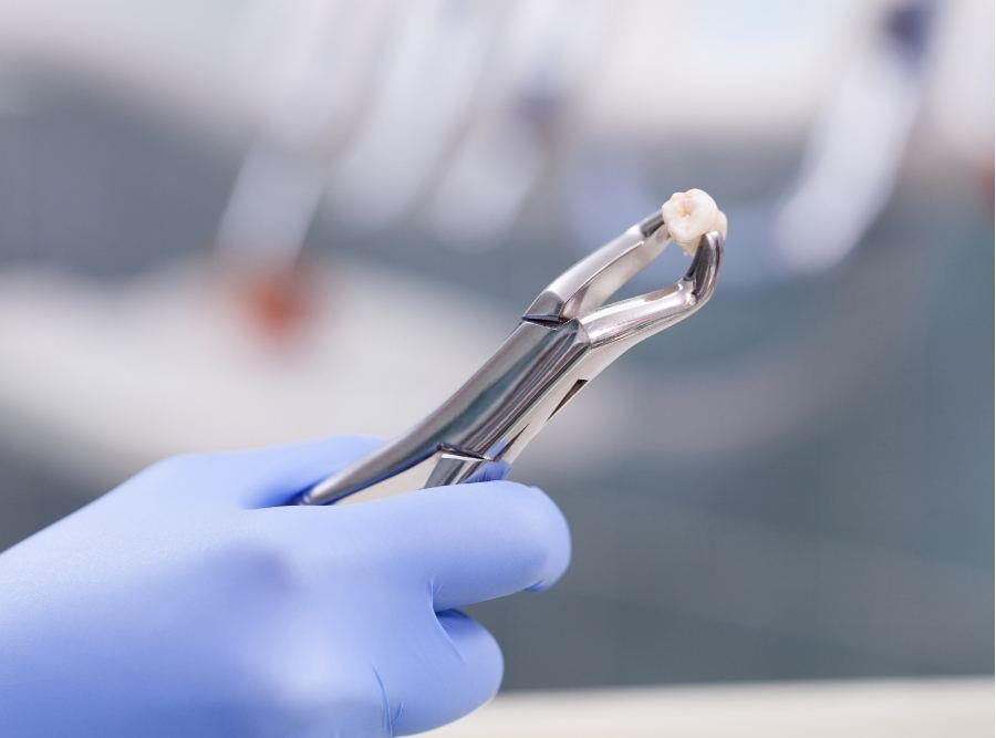Close-up of a dentist in pink surgical gloves using dental forceps to perform an extraction on a patient's lower molar.
