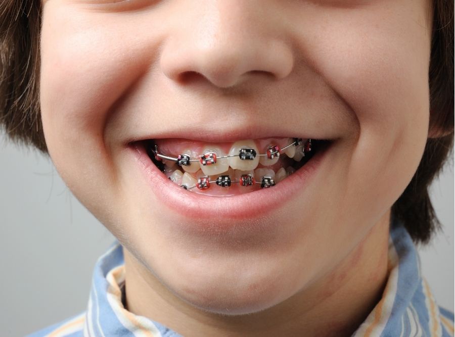 early age braces