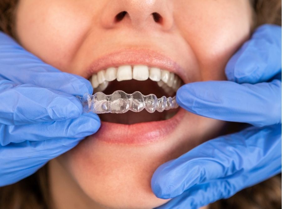 applying invisalign braces on a patient