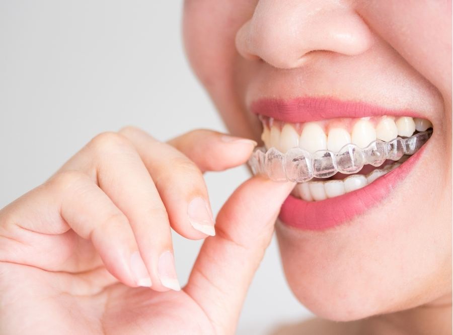 putting invisalign braces
